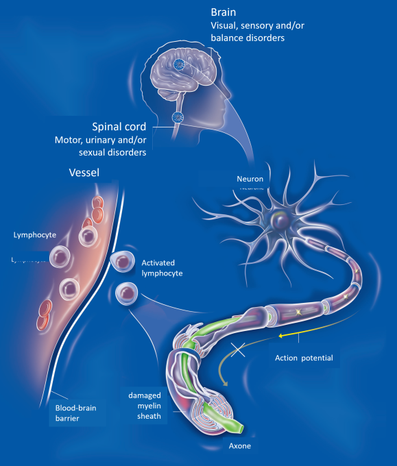 Ms Causes Multiple sclerosis and the environment: From the gut to the brain ...